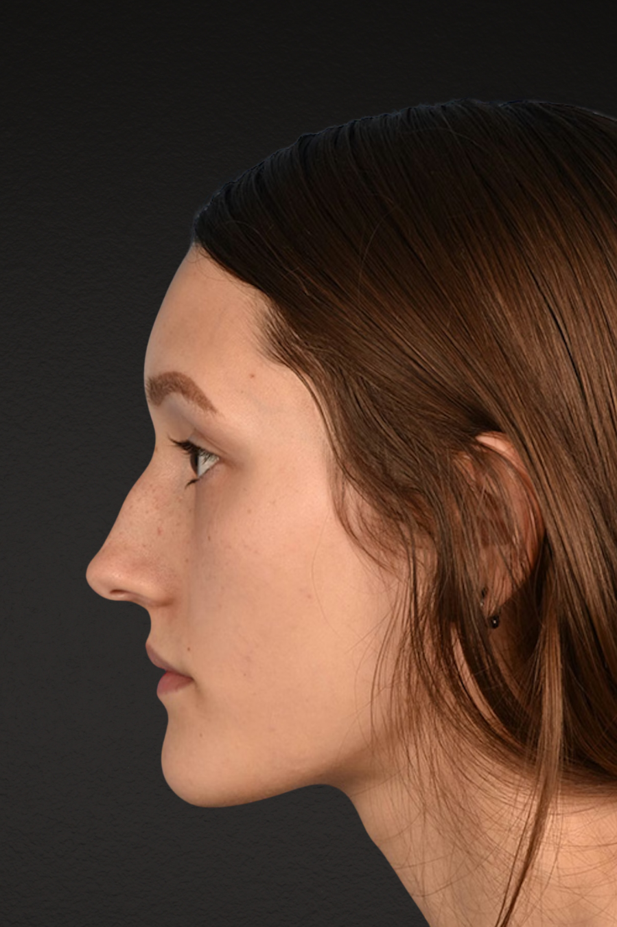 Rhinoplasty Before & After Gallery - Patient 399845 - Image 9