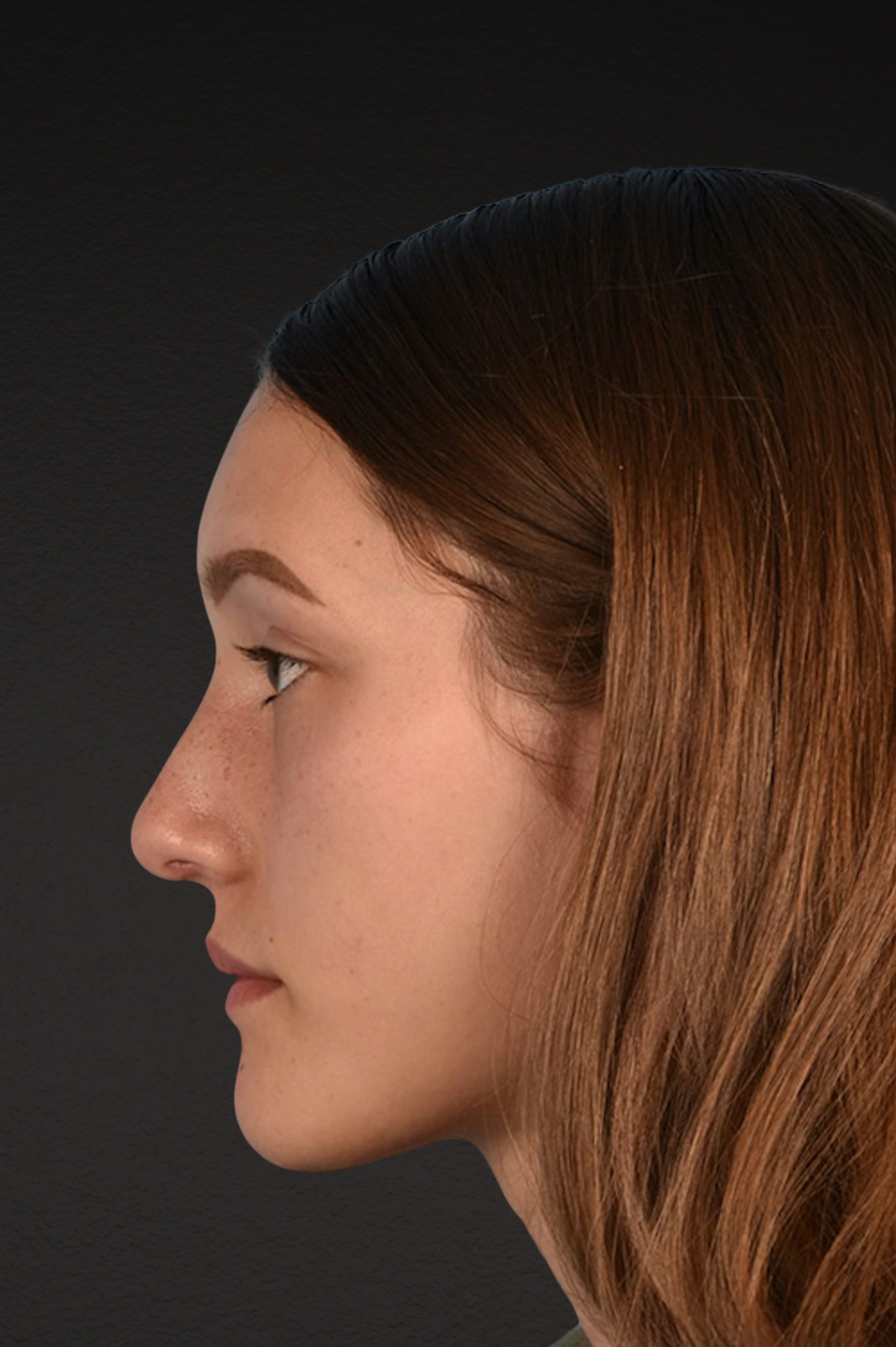 Rhinoplasty Before & After Gallery - Patient 399845 - Image 10