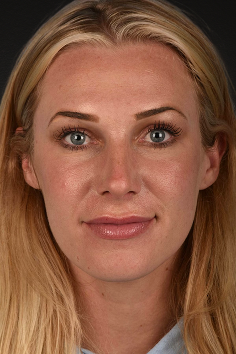 Rhinoplasty Before & After Gallery - Patient 791300 - Image 6