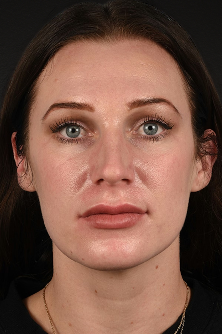 Rhinoplasty Before & After Gallery - Patient 791300 - Image 5