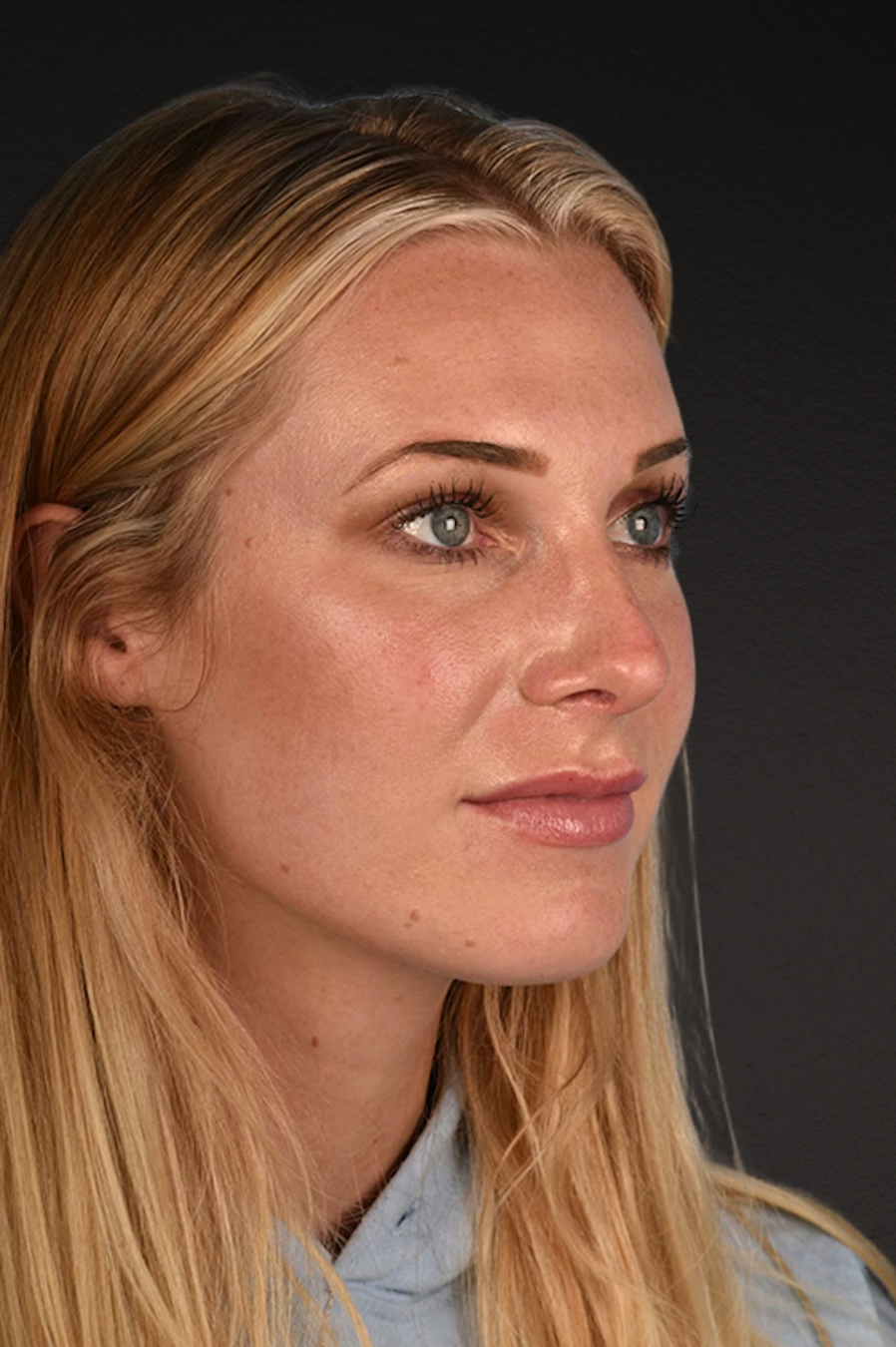 Rhinoplasty Before & After Gallery - Patient 791300 - Image 4