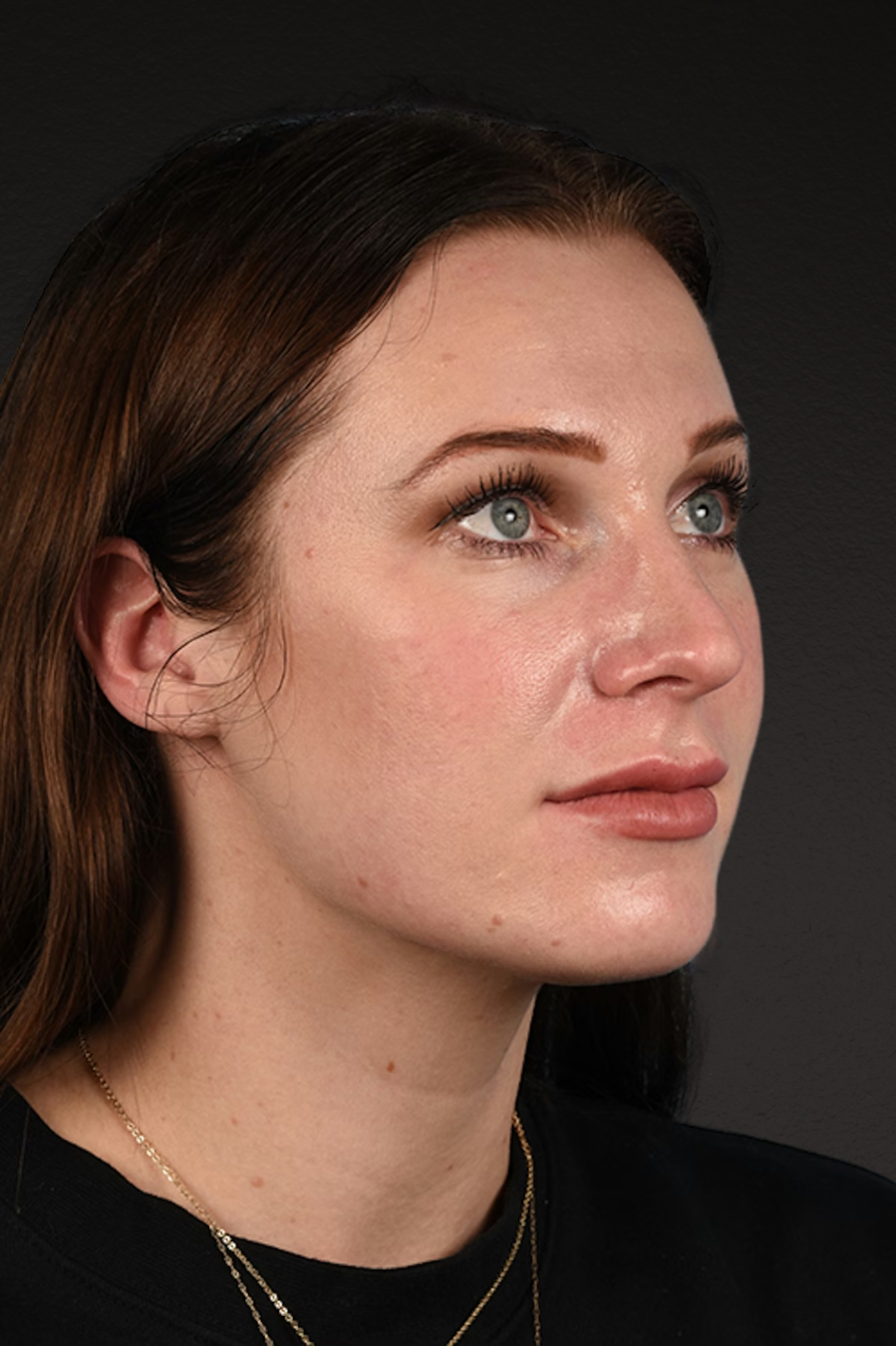 Rhinoplasty Before & After Gallery - Patient 791300 - Image 3