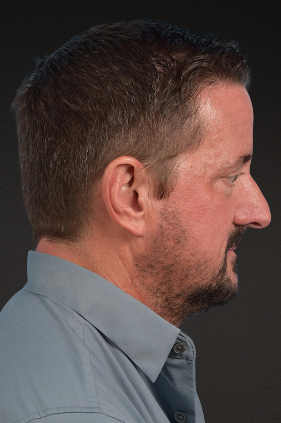 Rhinoplasty Before & After Gallery - Patient 381623 - Image 1