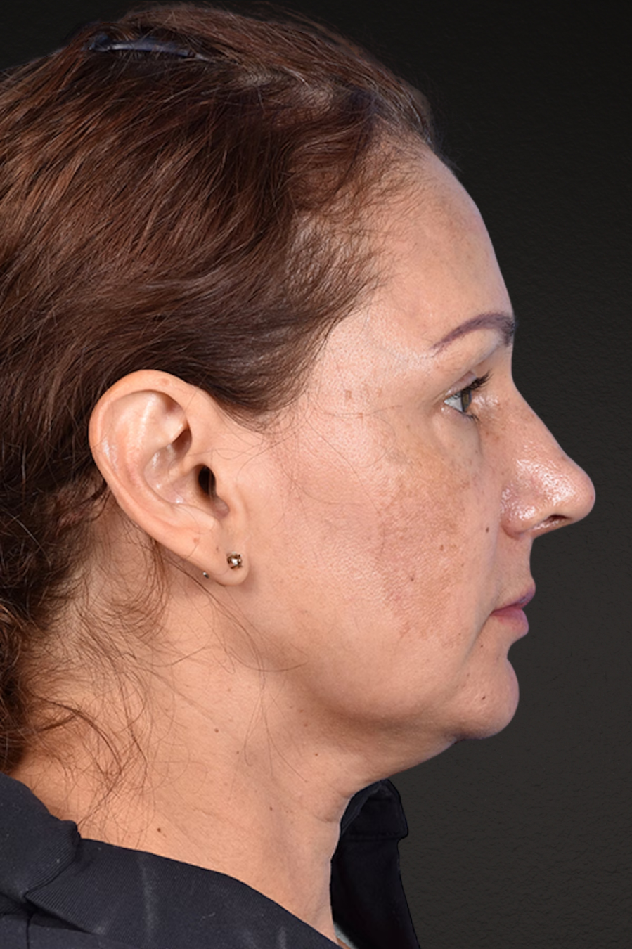 Rhinoplasty Before & After Gallery - Patient 178828 - Image 2