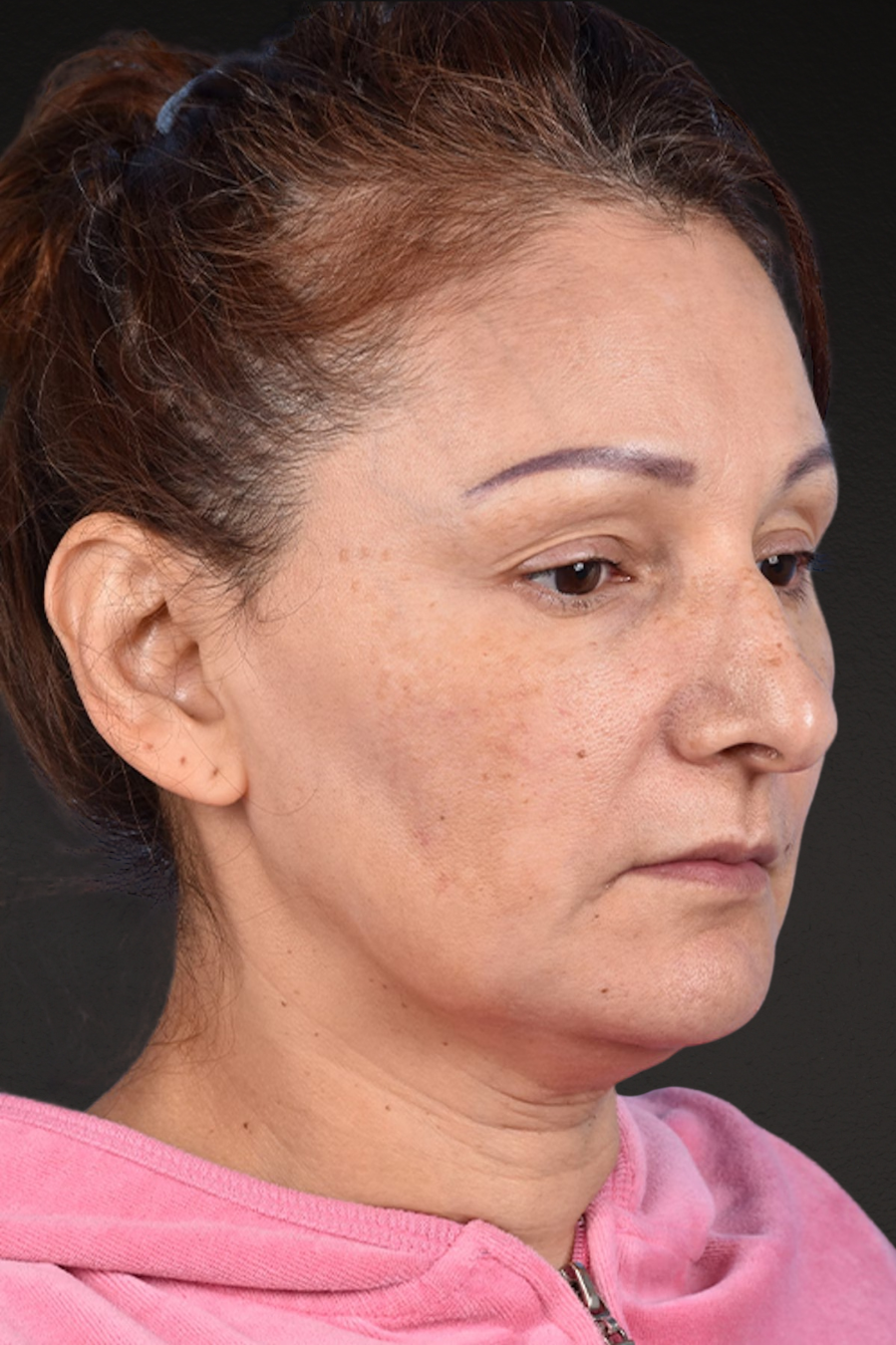 Rhinoplasty Before & After Gallery - Patient 178828 - Image 3