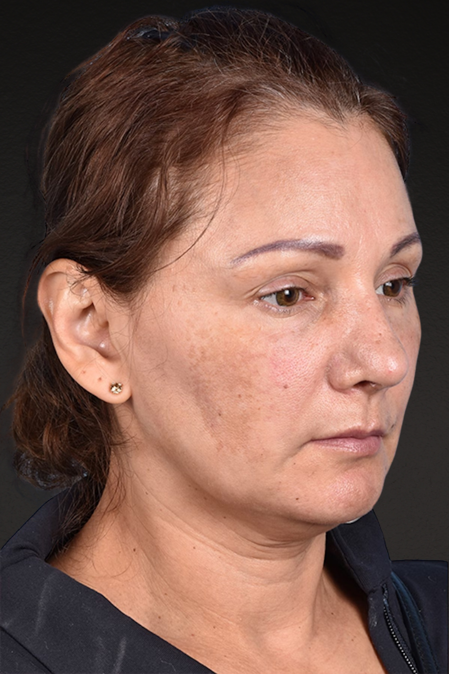 Rhinoplasty Before & After Gallery - Patient 178828 - Image 4