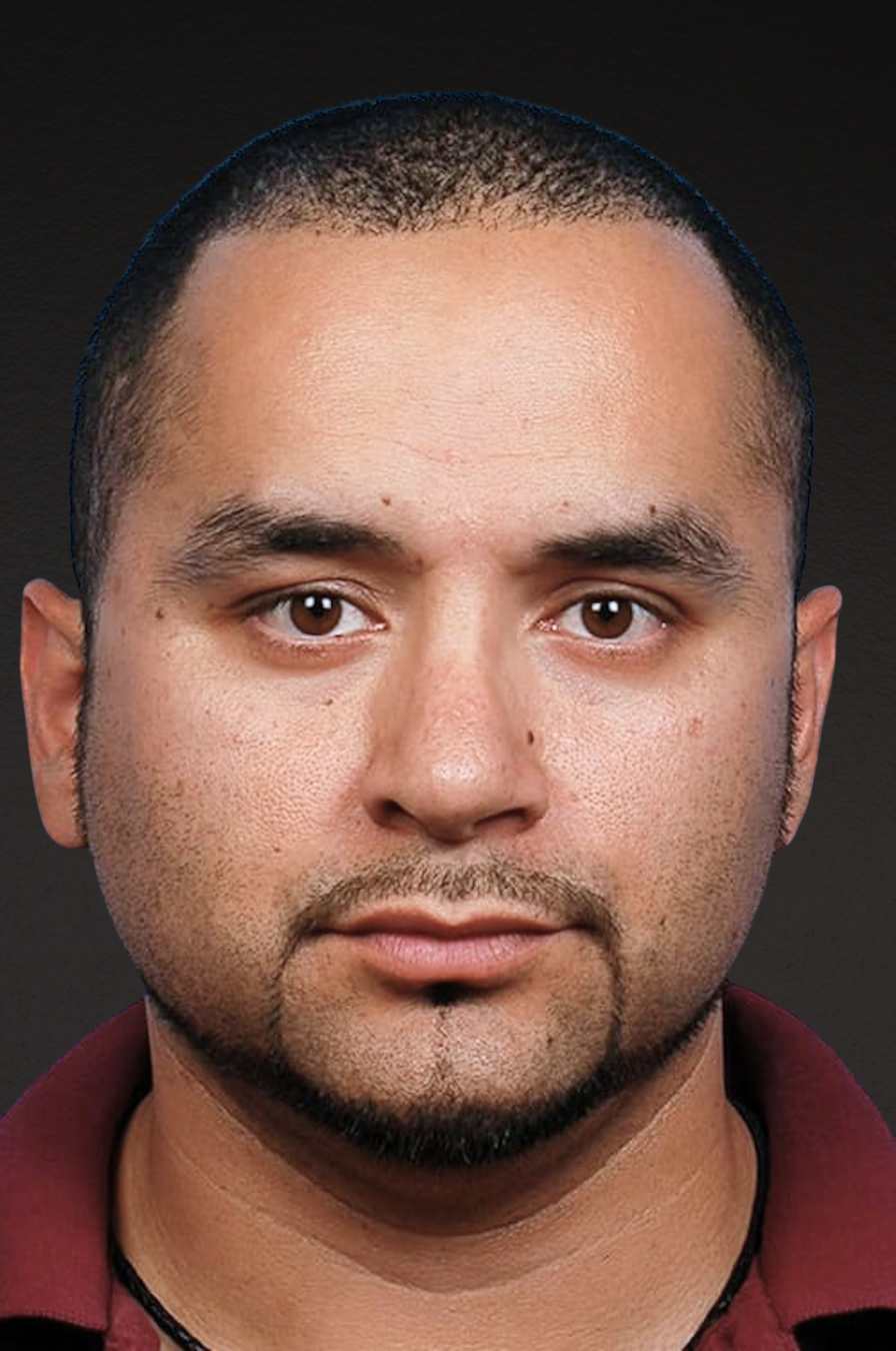 Rhinoplasty Before & After Gallery - Patient 237138 - Image 4