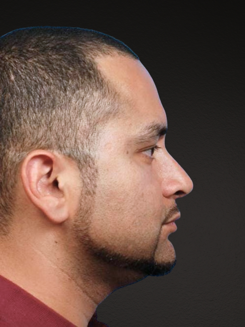 Rhinoplasty Before & After Gallery - Patient 237138 - Image 2