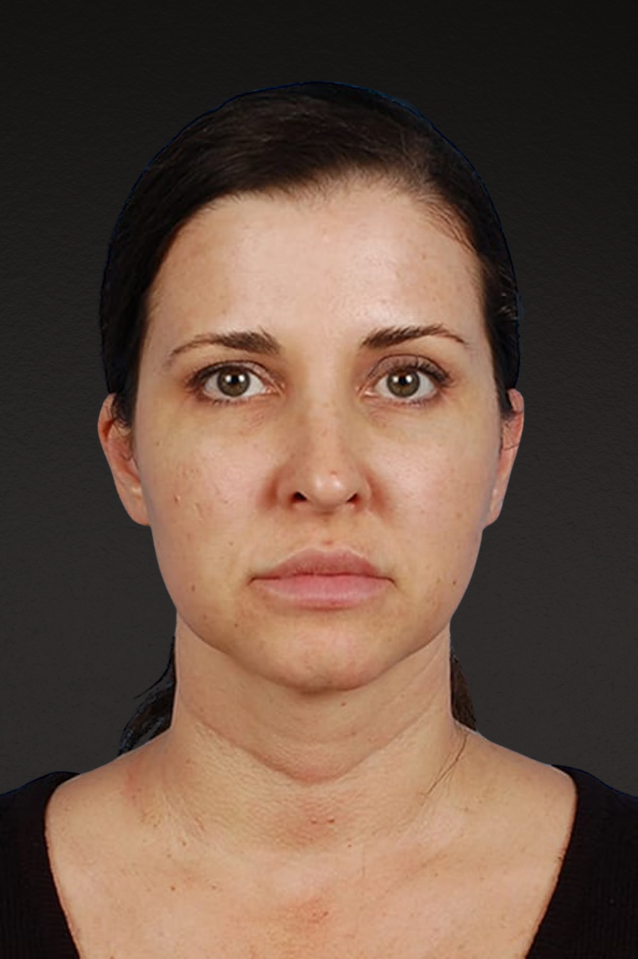 Rhinoplasty Before & After Gallery - Patient 378514 - Image 4