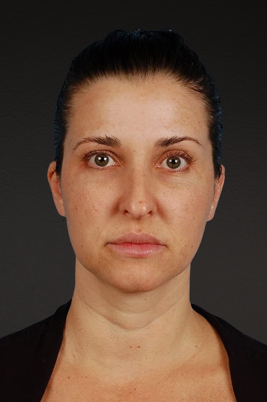 Rhinoplasty Before & After Gallery - Patient 378514 - Image 3