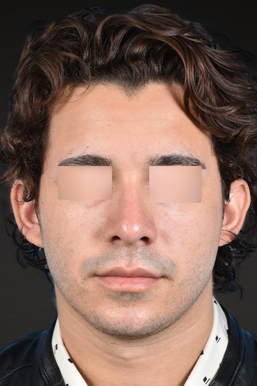 Rhinoplasty Before & After Gallery - Patient 323731 - Image 10