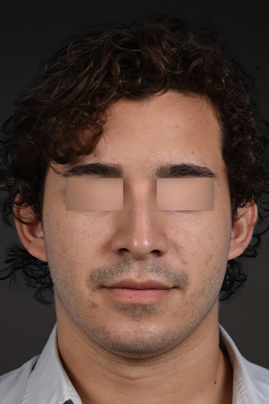 Rhinoplasty Before & After Gallery - Patient 323731 - Image 9