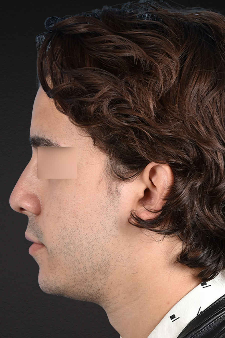 Rhinoplasty Before & After Gallery - Patient 323731 - Image 6
