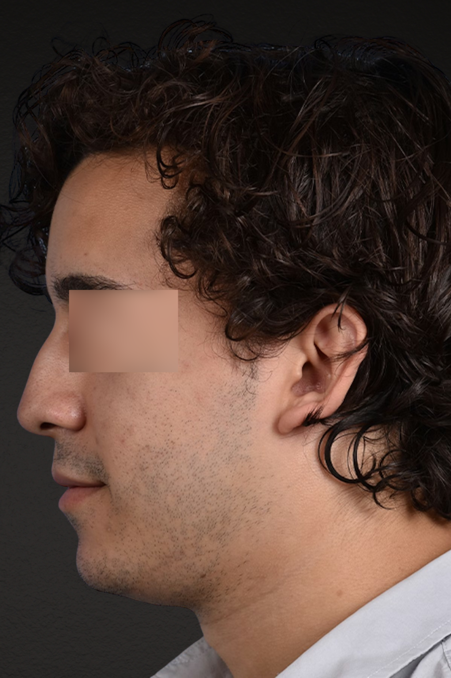 Rhinoplasty Before & After Gallery - Patient 323731 - Image 5