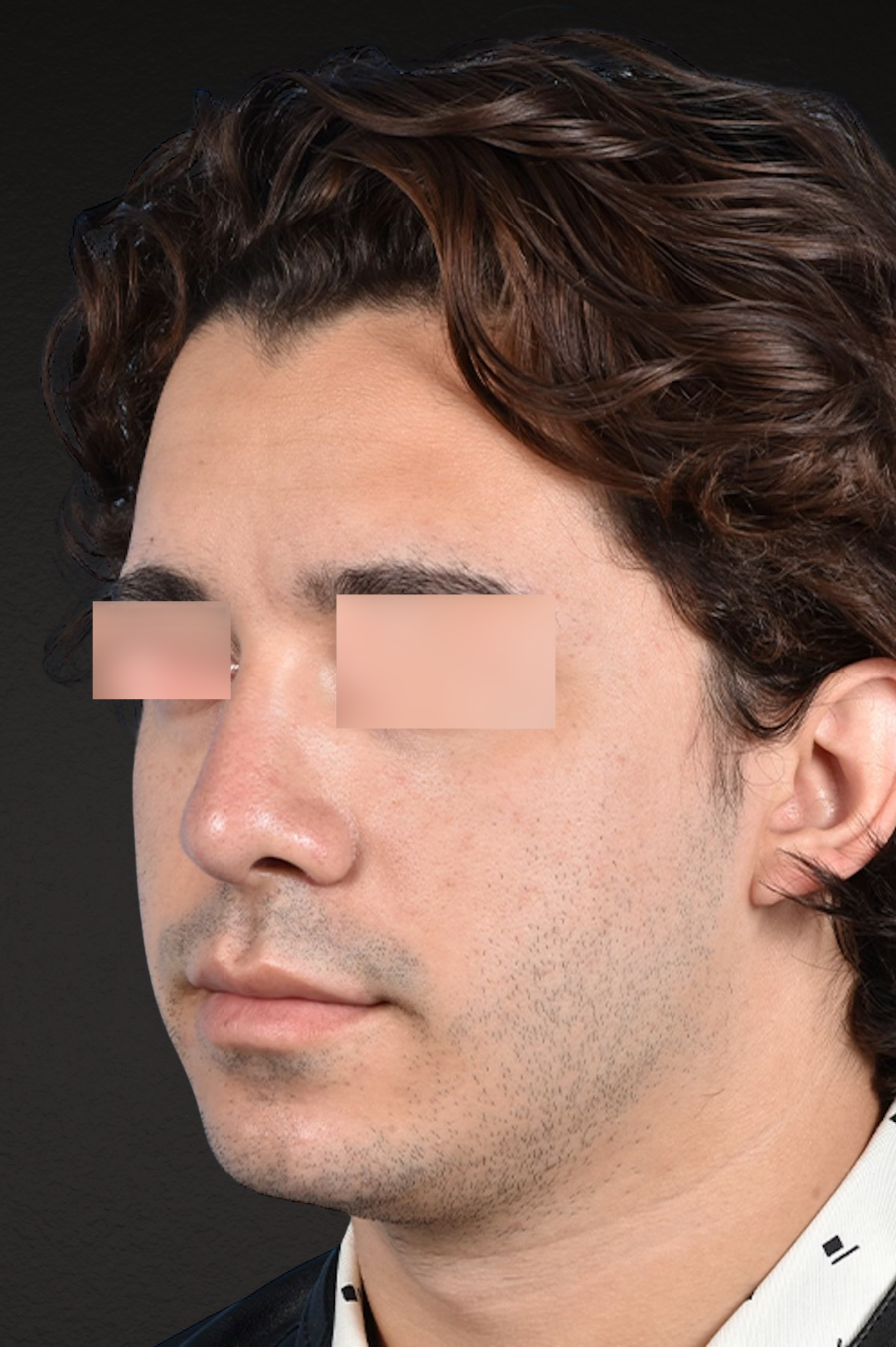 Rhinoplasty Before & After Gallery - Patient 323731 - Image 4
