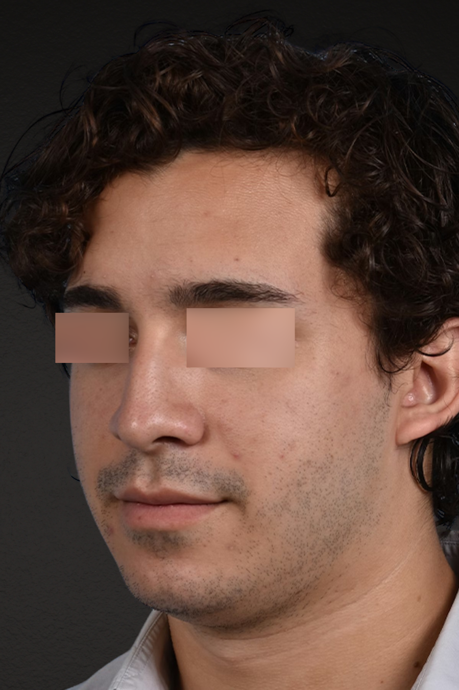 Rhinoplasty Before & After Gallery - Patient 323731 - Image 3