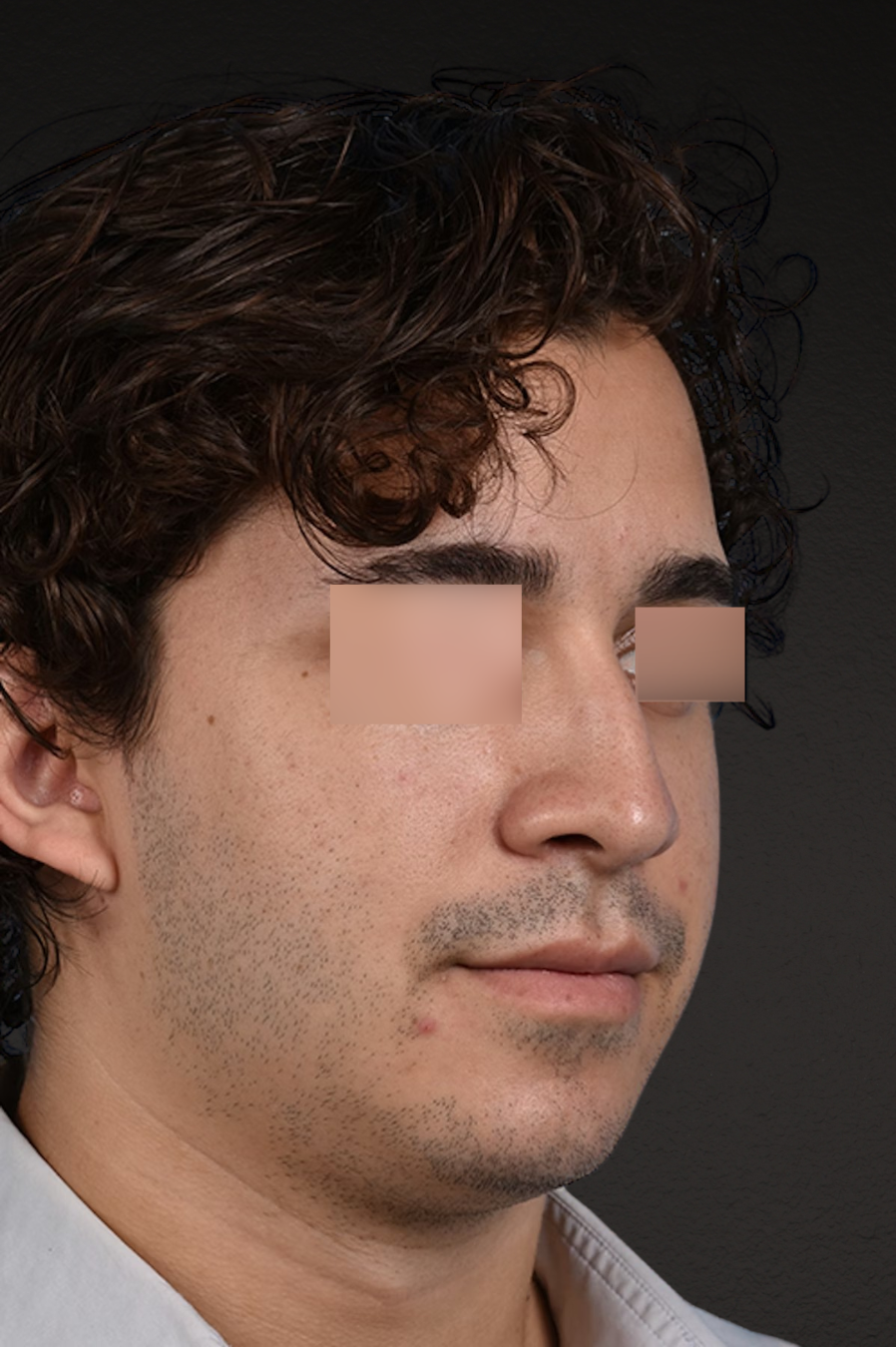 Rhinoplasty Before & After Gallery - Patient 323731 - Image 7