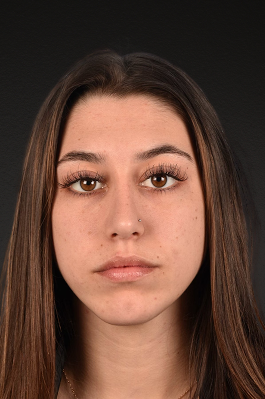Rhinoplasty Before & After Gallery - Patient 304396 - Image 4