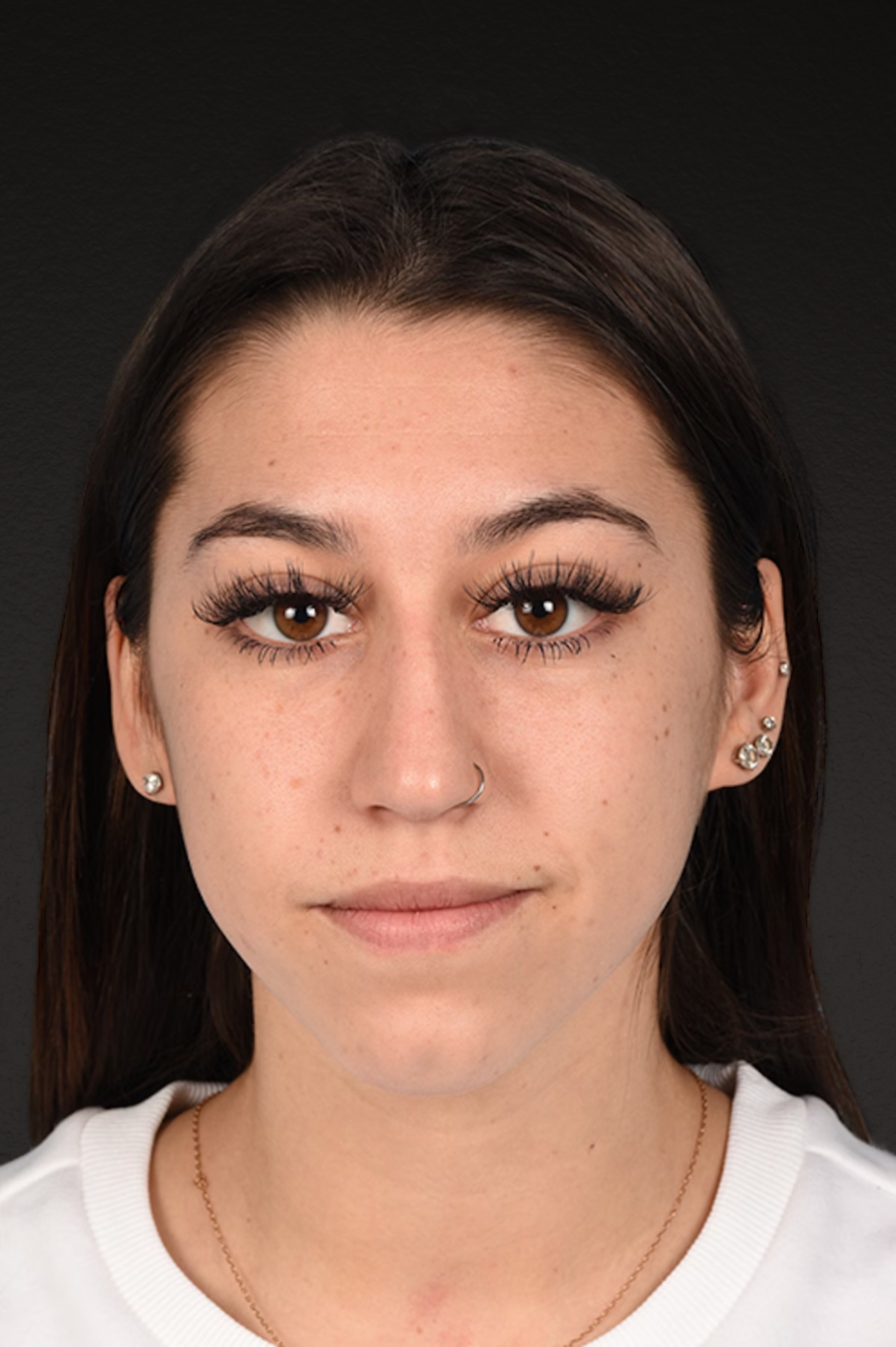 Rhinoplasty Before & After Gallery - Patient 304396 - Image 3