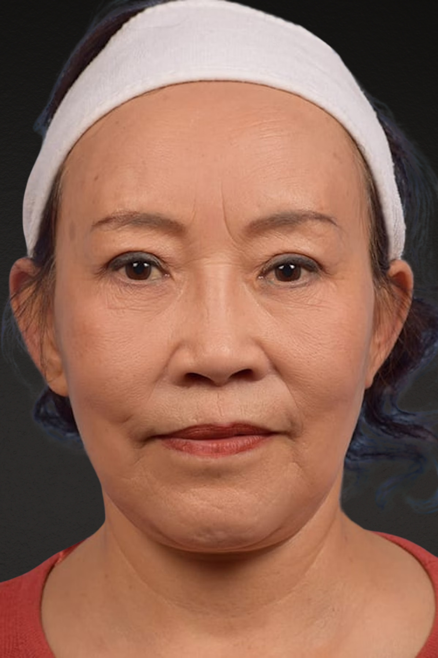 Rhinoplasty Before & After Gallery - Patient 115275 - Image 6