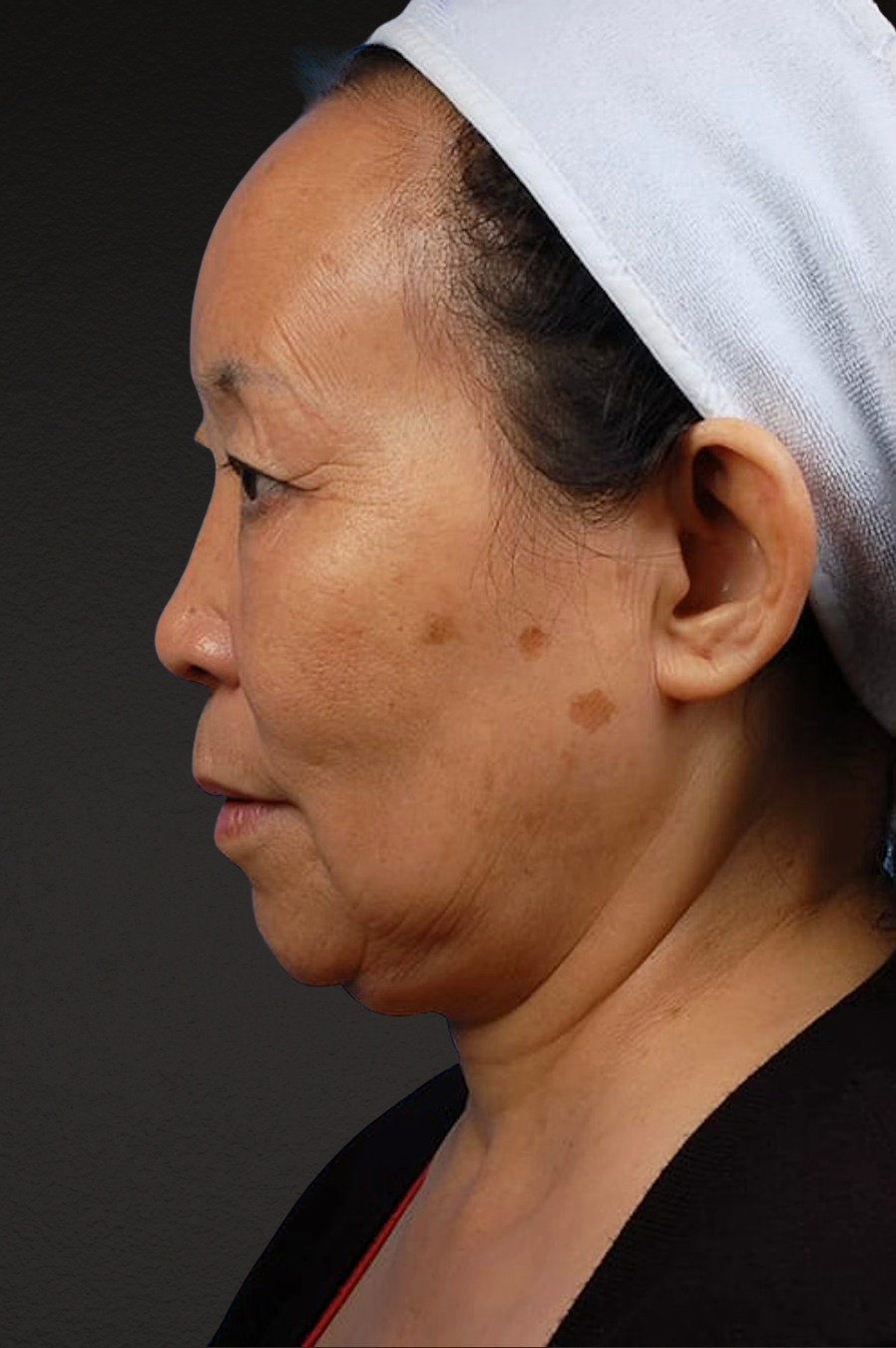 Rhinoplasty Before & After Gallery - Patient 115275 - Image 1