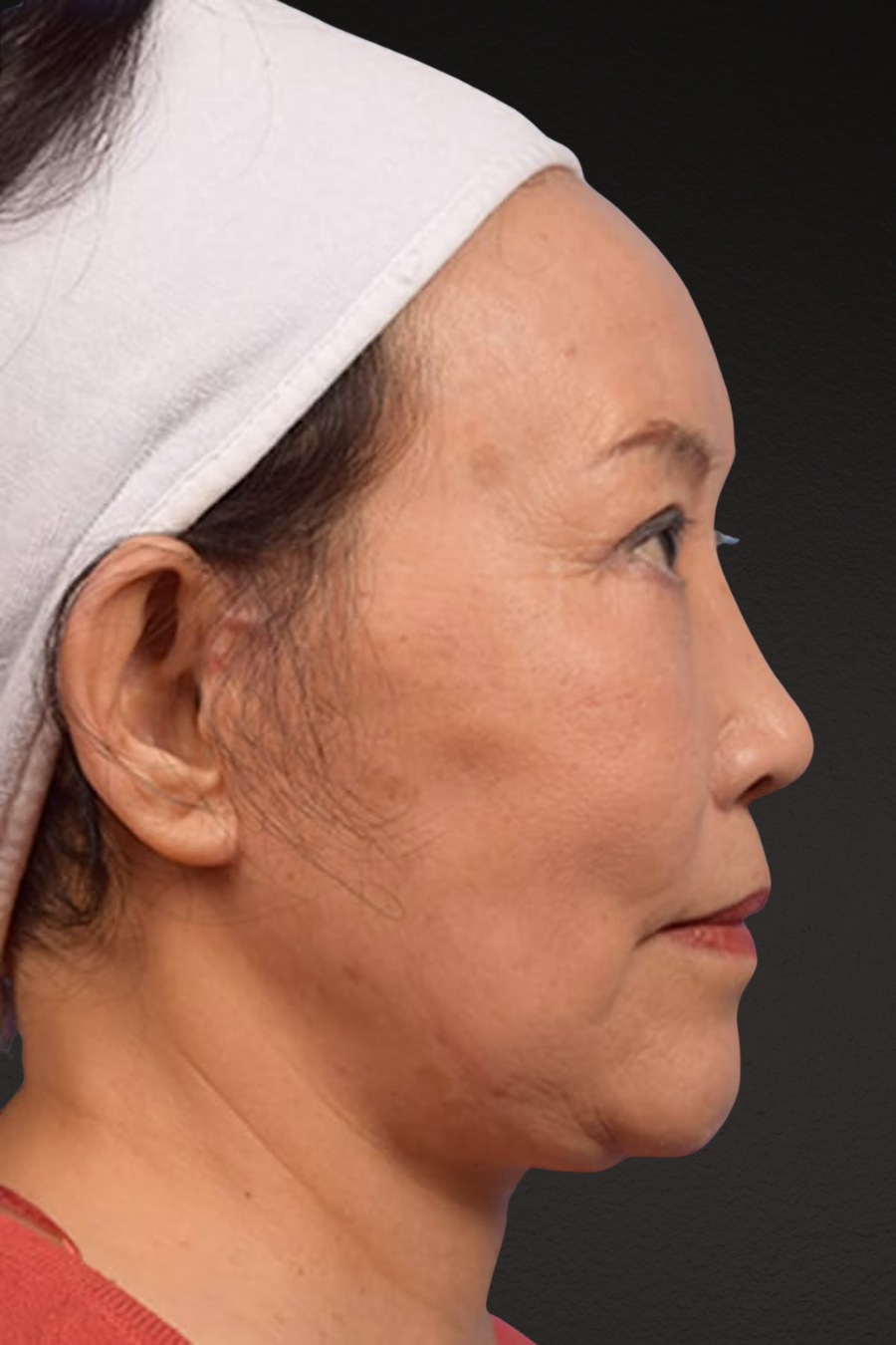 Rhinoplasty Before & After Gallery - Patient 115275 - Image 4