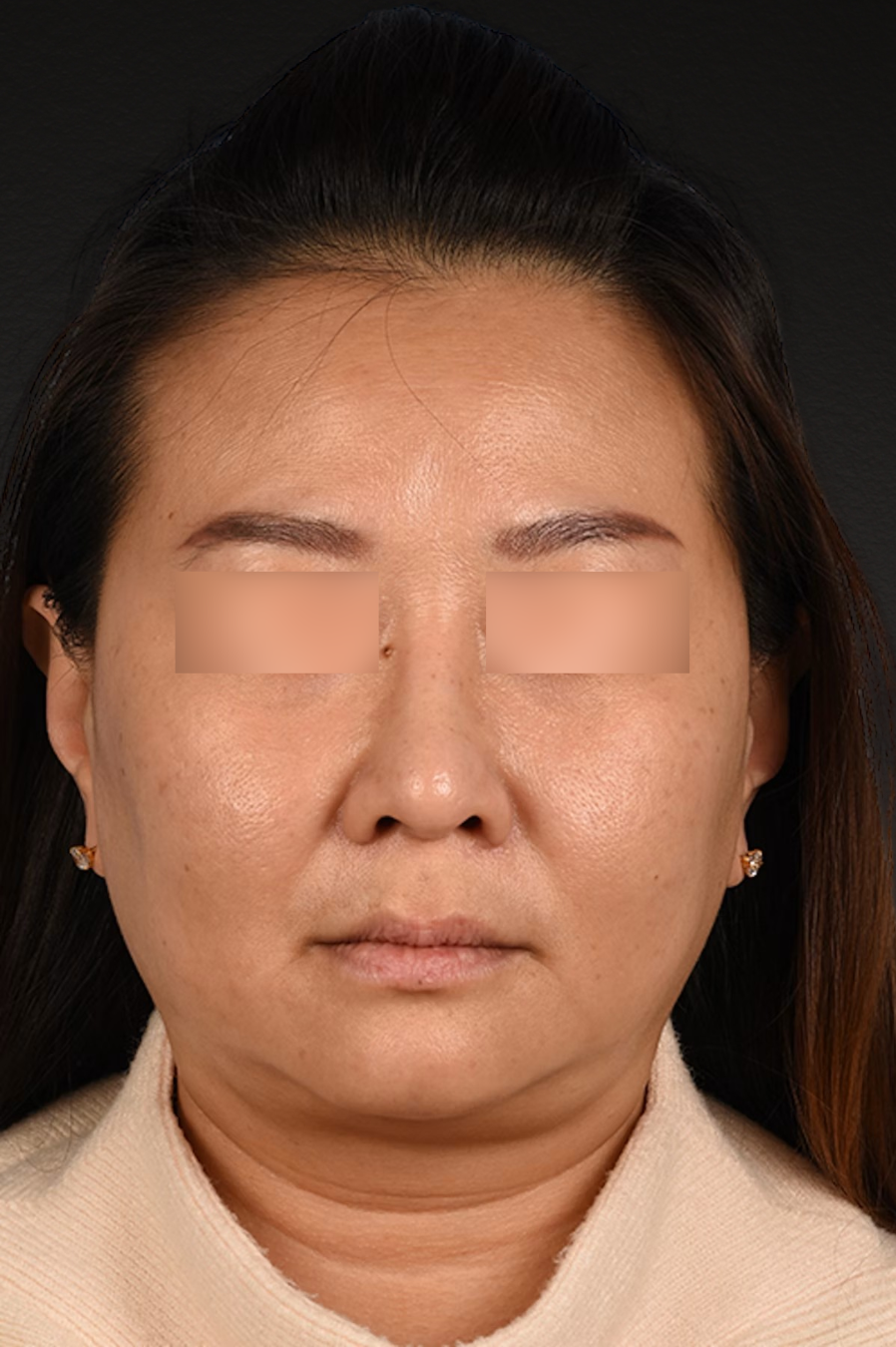 Rhinoplasty Before & After Gallery - Patient 403670 - Image 6