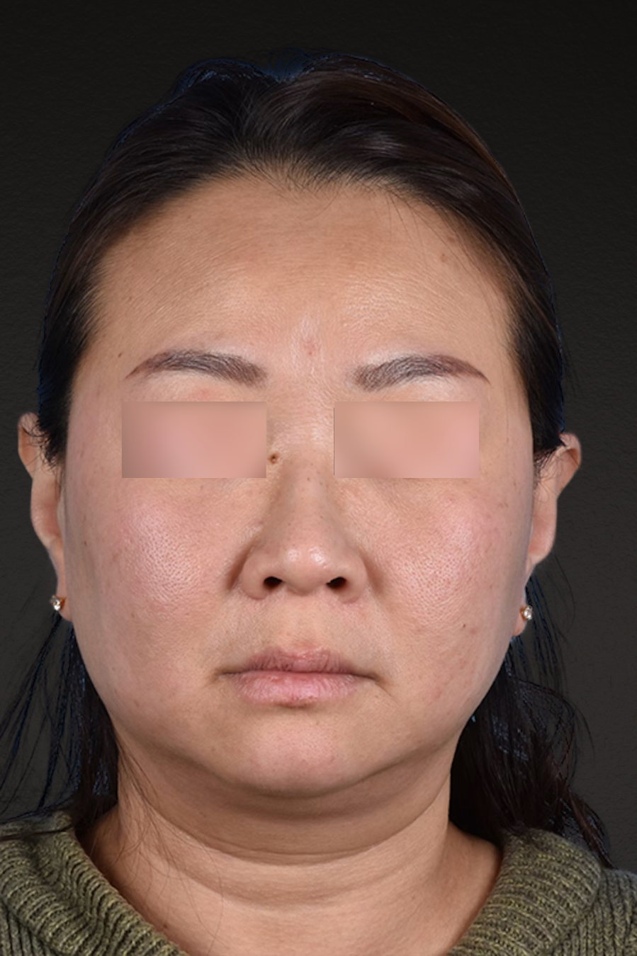 Rhinoplasty Before & After Gallery - Patient 403670 - Image 5