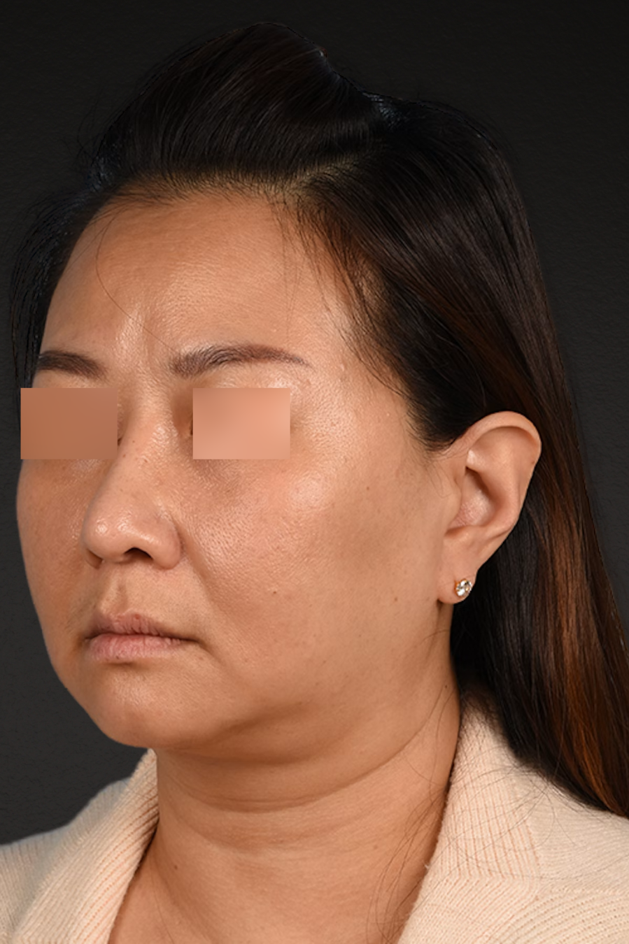 Rhinoplasty Before & After Gallery - Patient 403670 - Image 4