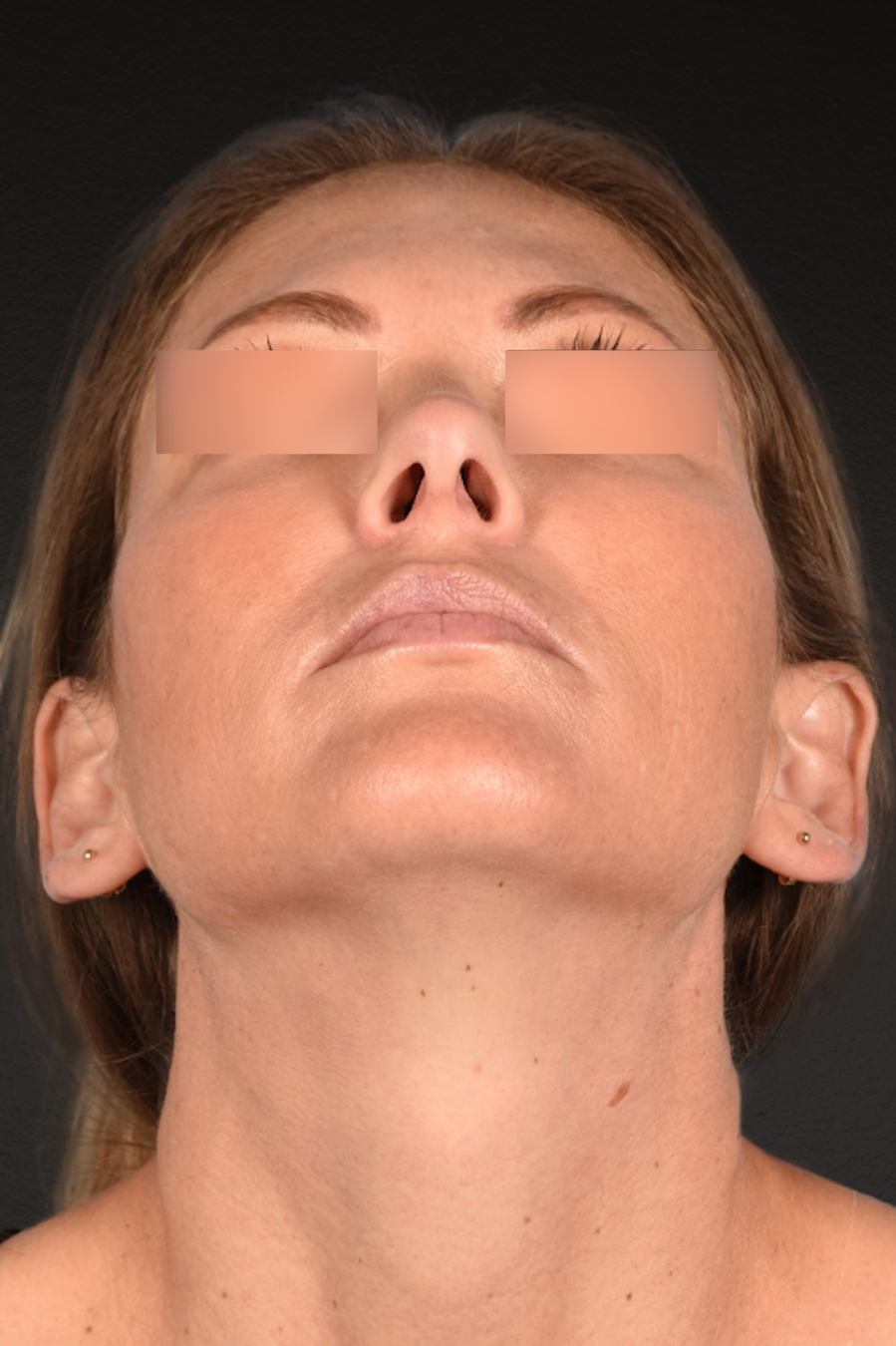 Rhinoplasty Before & After Gallery - Patient 117002 - Image 6