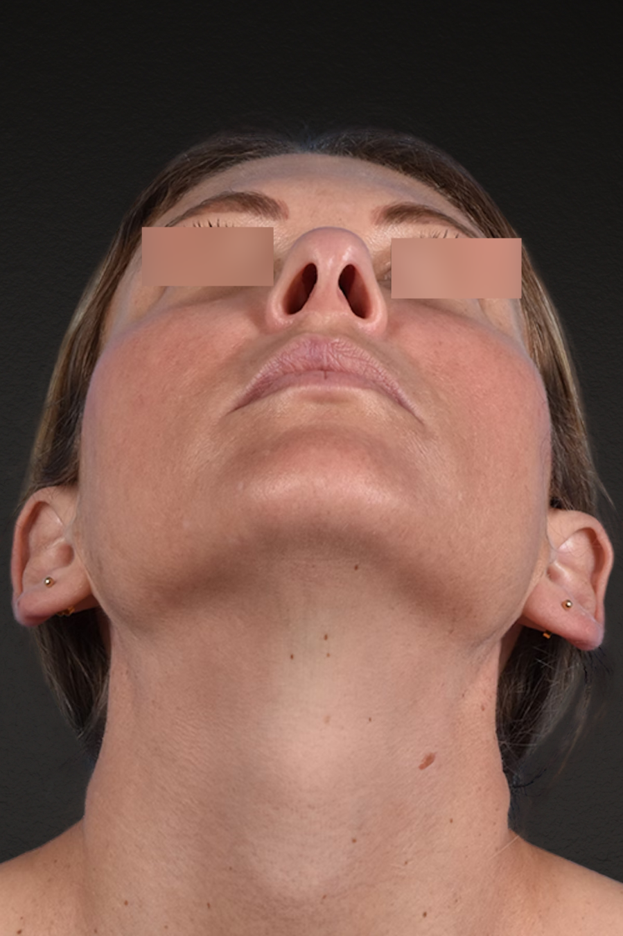 Rhinoplasty Before & After Gallery - Patient 117002 - Image 5