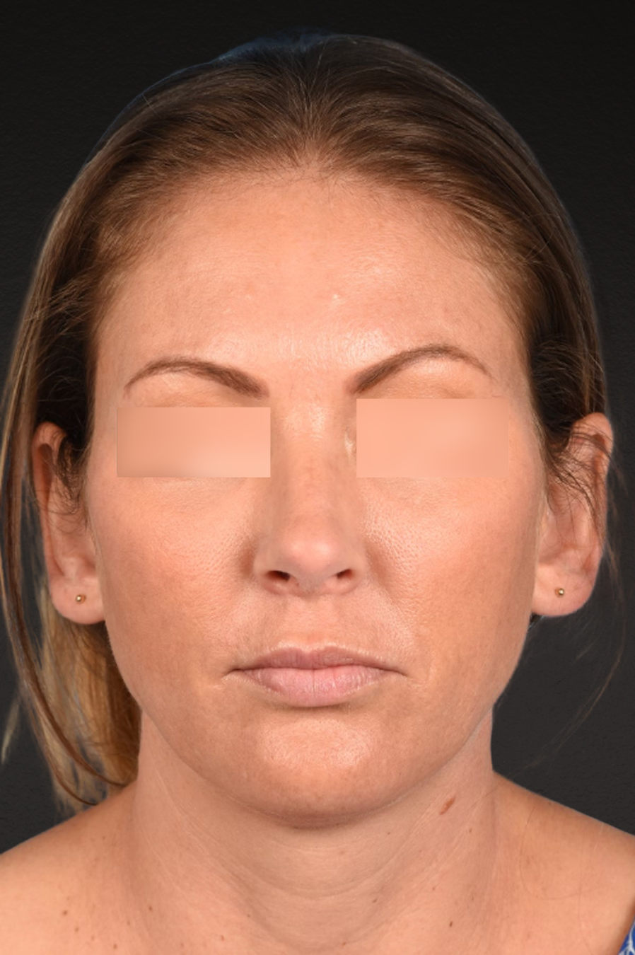 Rhinoplasty Before & After Gallery - Patient 117002 - Image 4