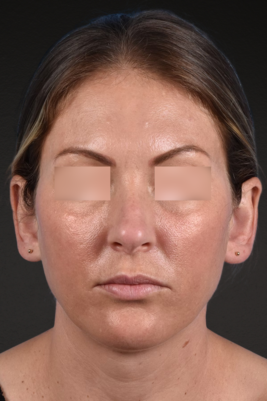 Rhinoplasty Before & After Gallery - Patient 117002 - Image 3