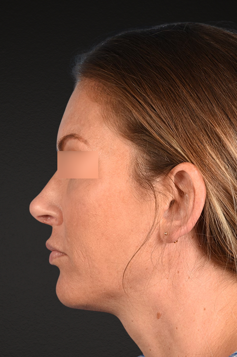 Rhinoplasty Before & After Gallery - Patient 117002 - Image 2