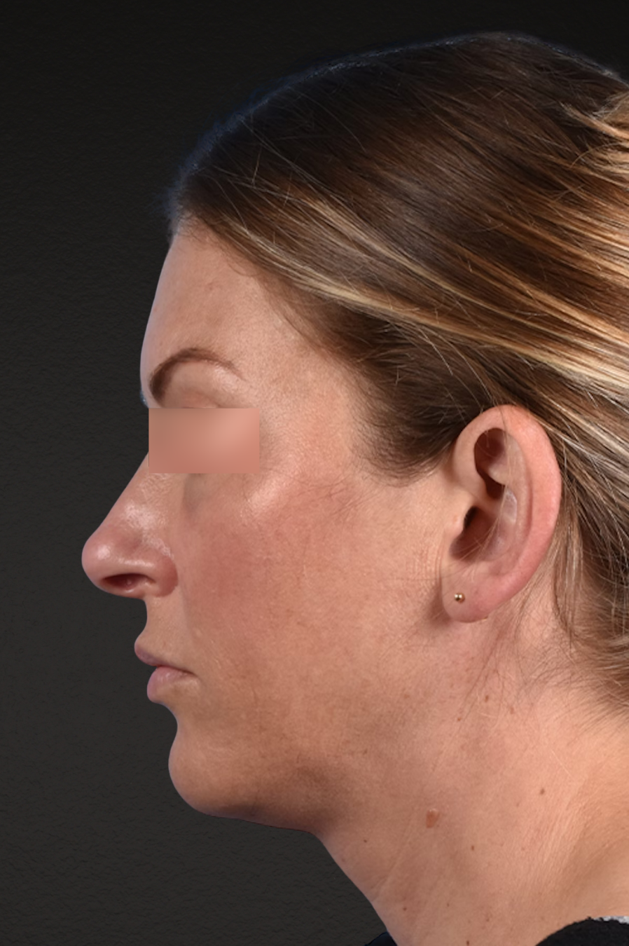 Rhinoplasty Before & After Gallery - Patient 117002 - Image 1
