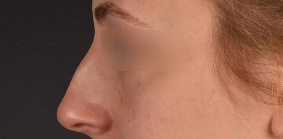 Rhinoplasty Before & After Gallery - Patient 265382 - Image 1
