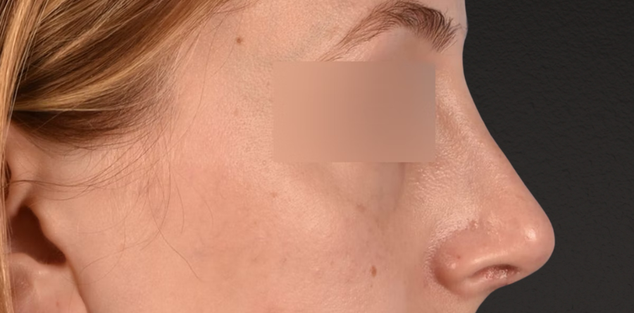 Rhinoplasty Before & After Gallery - Patient 265382 - Image 4