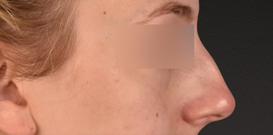 Rhinoplasty Before & After Gallery - Patient 265382 - Image 3