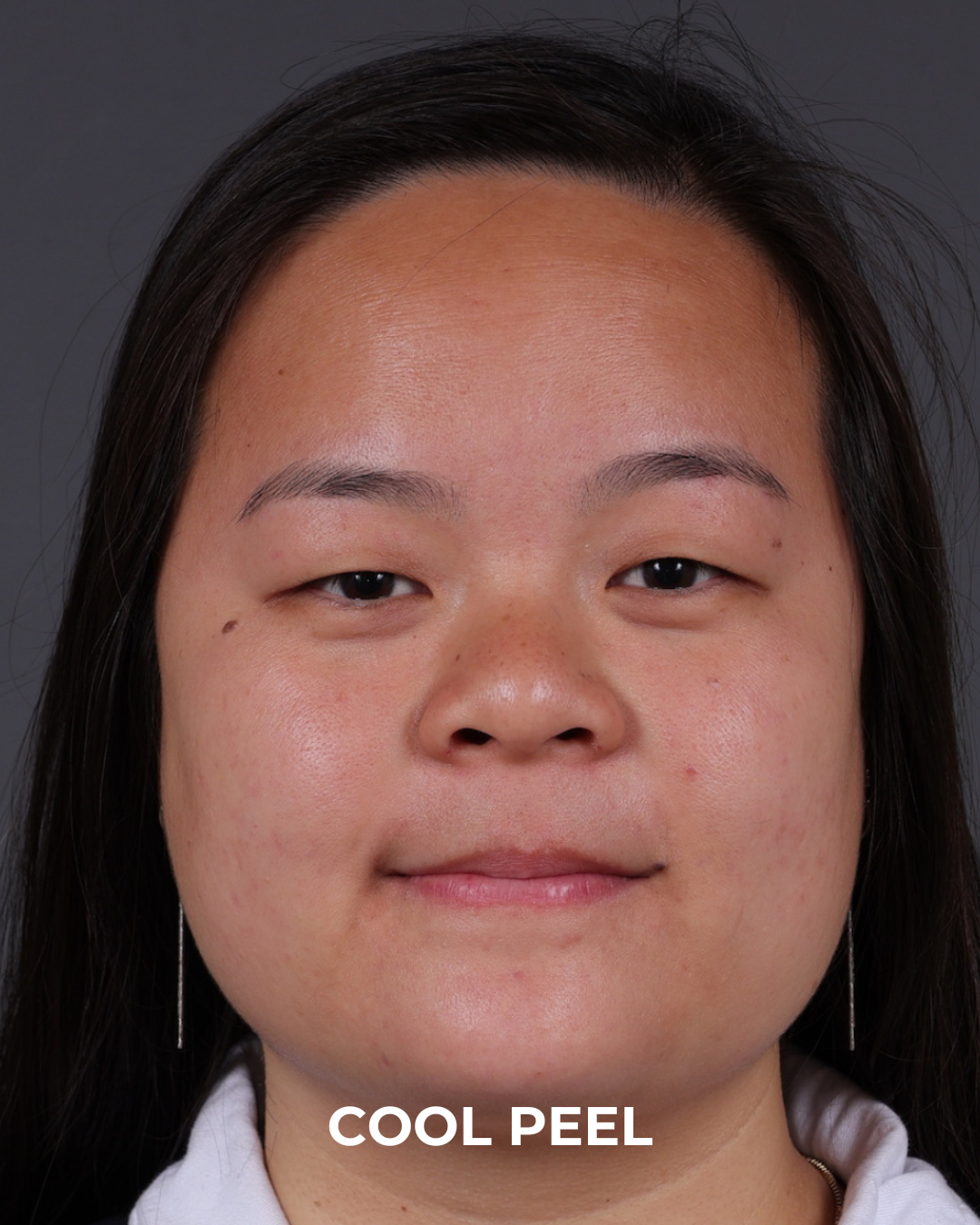 Co2 Laser Before & After Gallery - Patient 416341 - Image 5