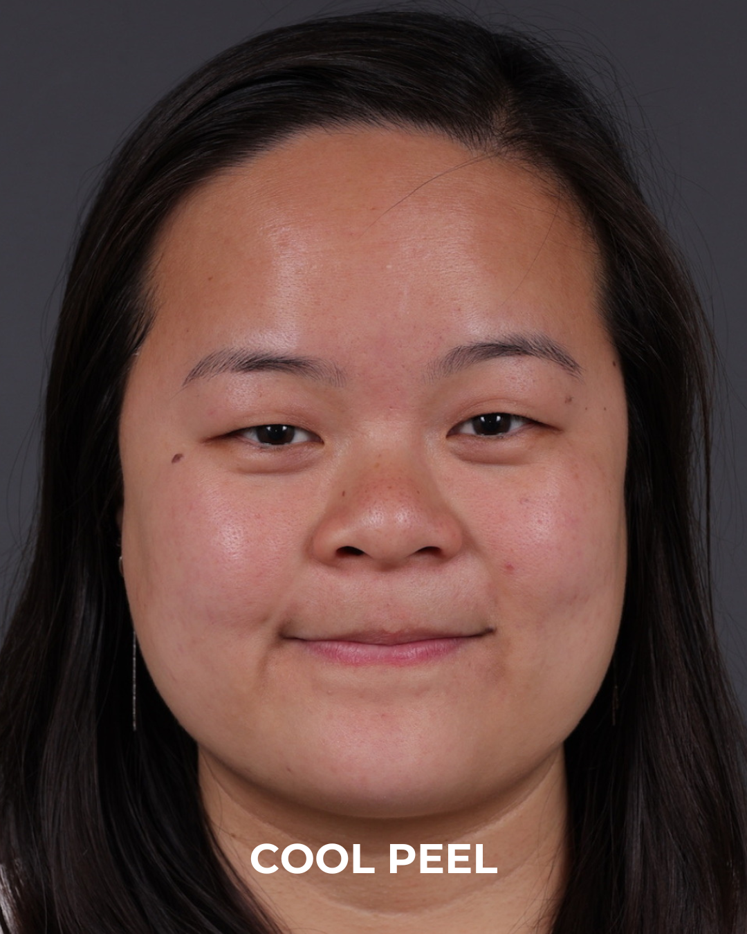 Co2 Laser Before & After Gallery - Patient 416341 - Image 6