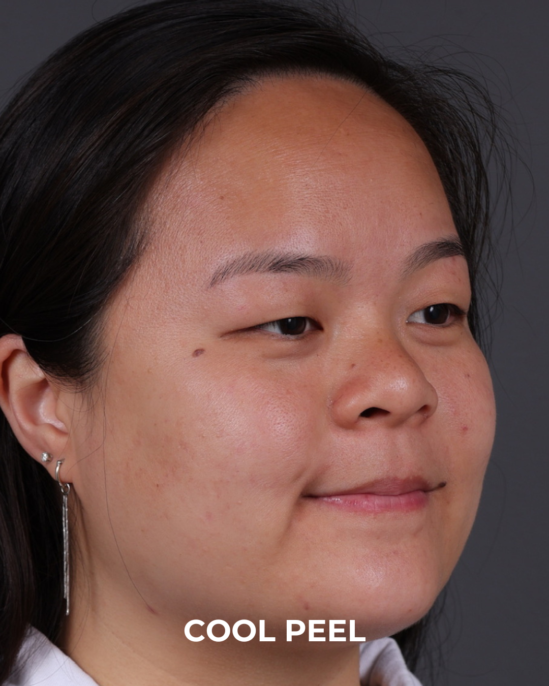 Co2 Laser Before & After Gallery - Patient 416341 - Image 1