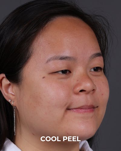Co2 Laser Before & After Gallery - Patient 416341 - Image 1