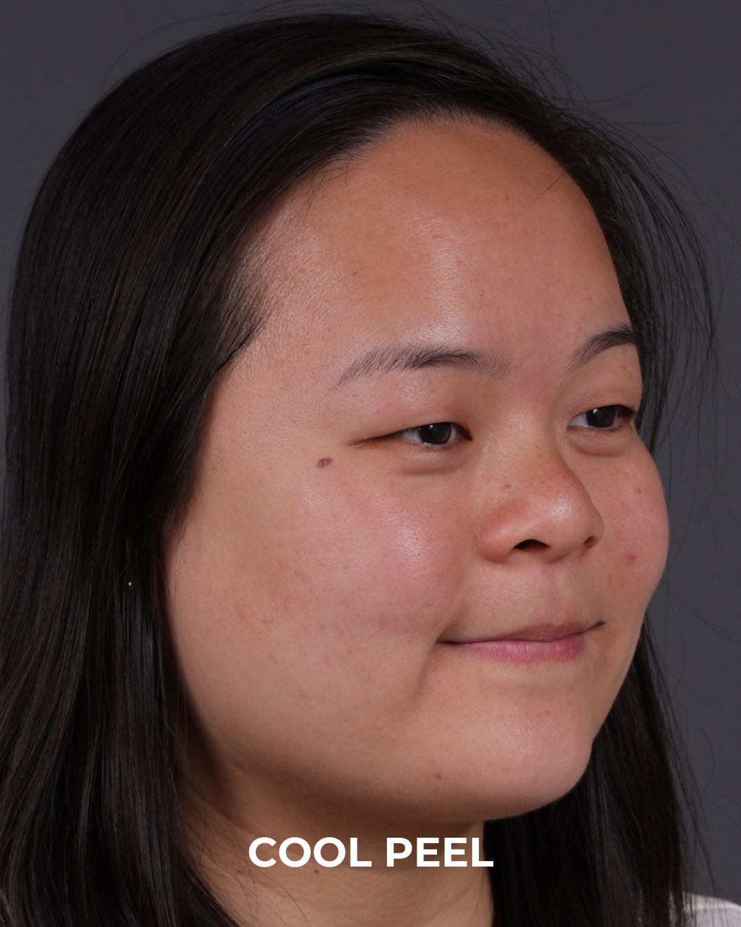 Co2 Laser Before & After Gallery - Patient 416341 - Image 2