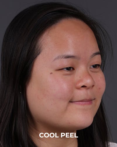 Co2 Laser Before & After Gallery - Patient 416341 - Image 2
