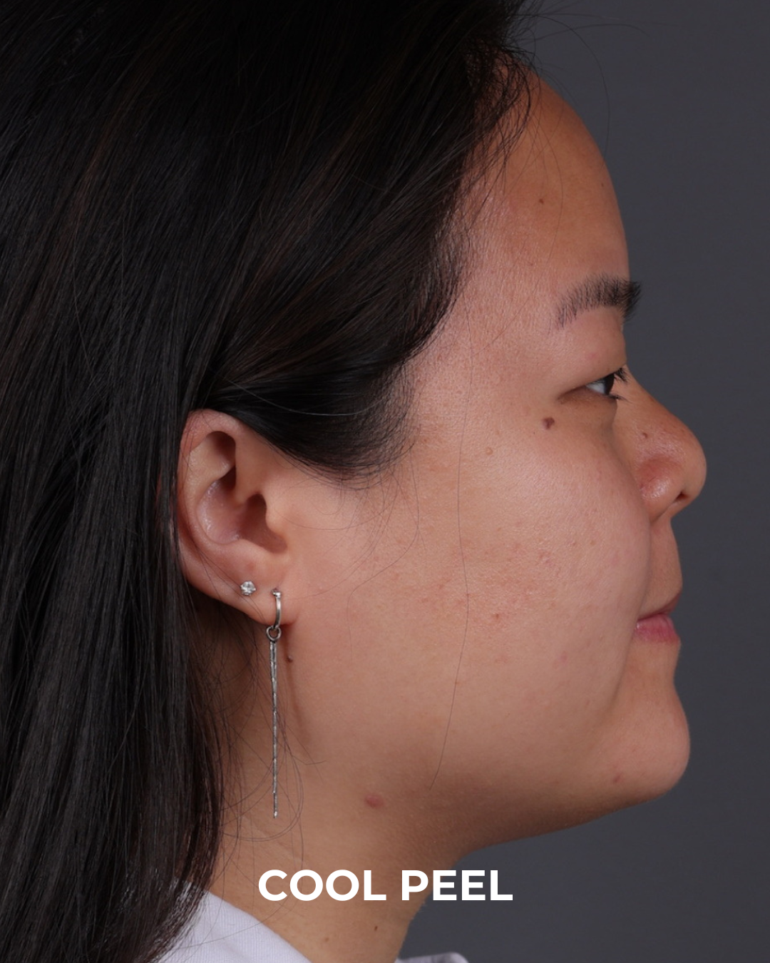 Co2 Laser Before & After Gallery - Patient 416341 - Image 3