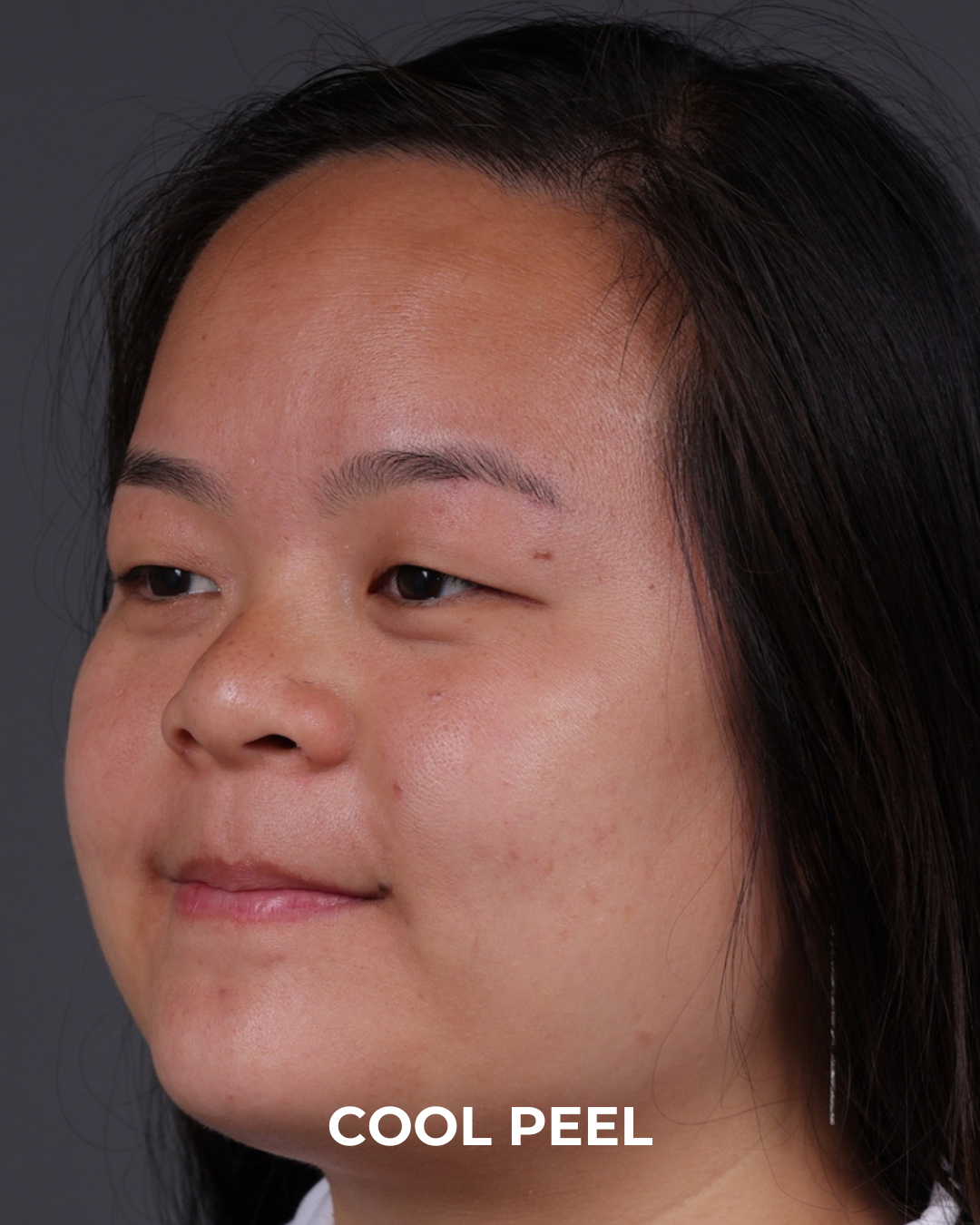 Co2 Laser Before & After Gallery - Patient 416341 - Image 7