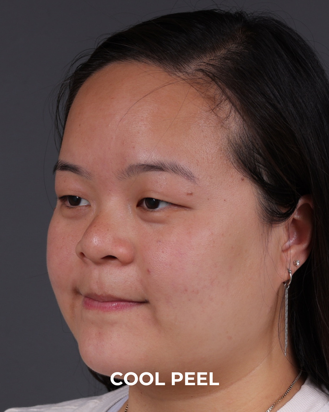 Co2 Laser Before & After Gallery - Patient 416341 - Image 8