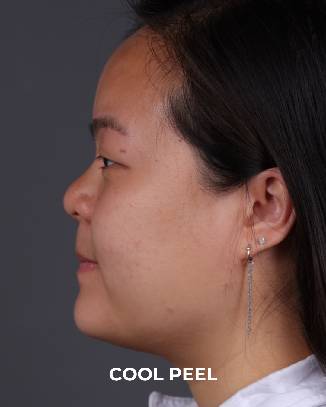 Co2 Laser Before & After Gallery - Patient 416341 - Image 9