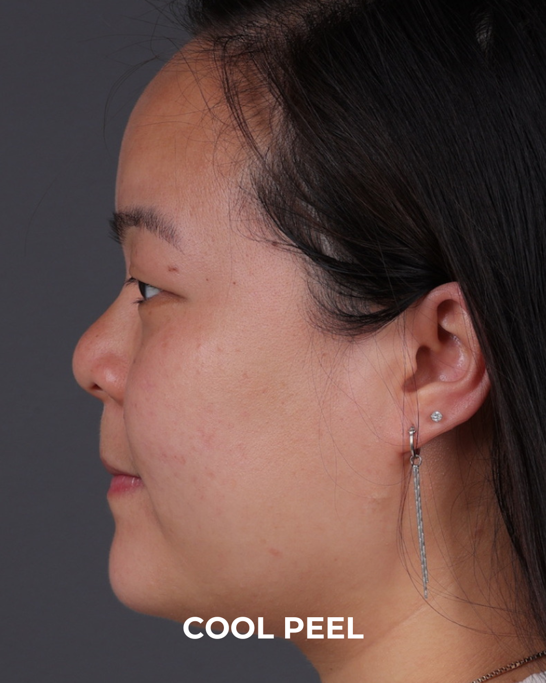 Co2 Laser Before & After Gallery - Patient 416341 - Image 10