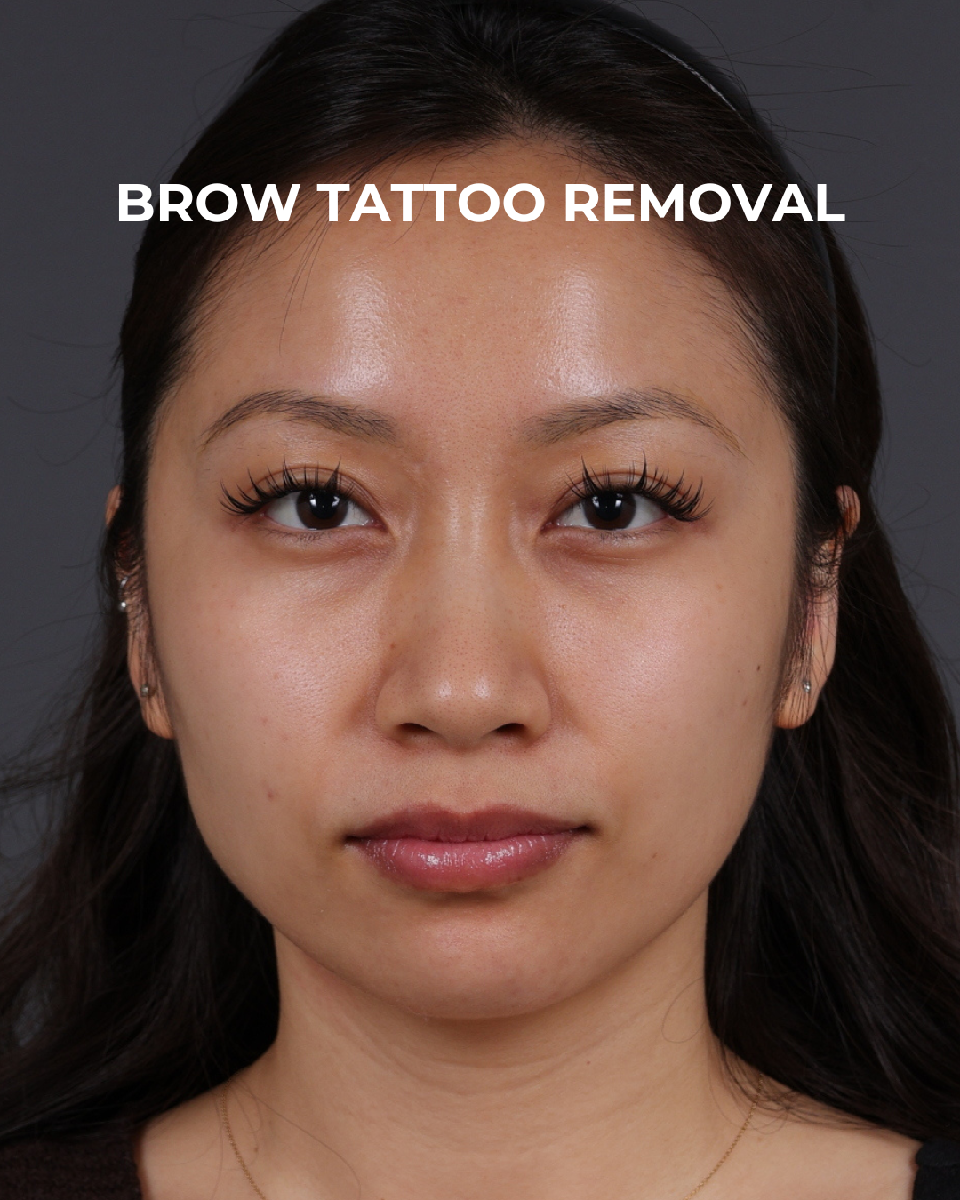 Brow Tattoo Removal Before & After Gallery - Patient 179499 - Image 2